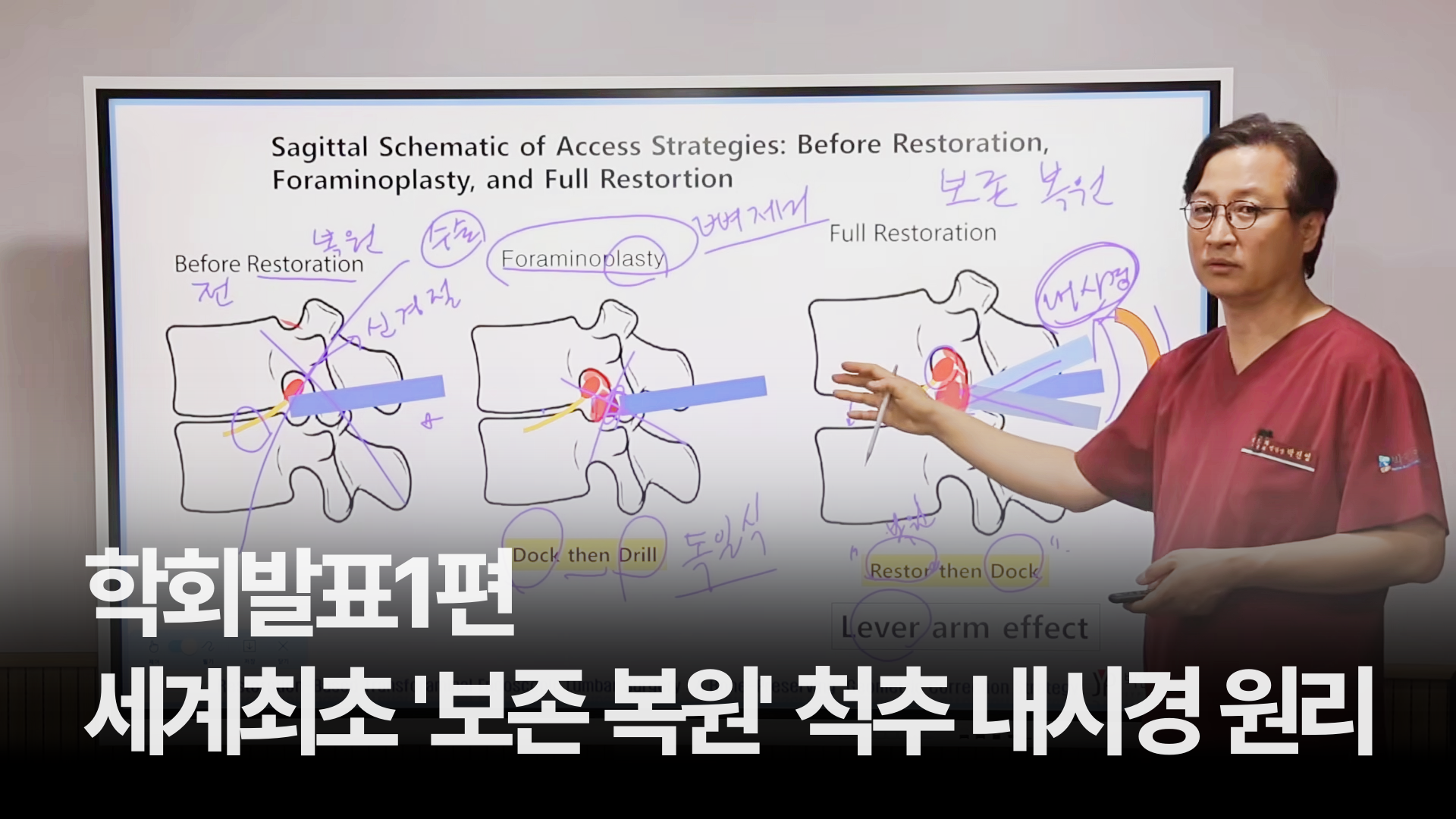 [학회발표1편] 디스크 뼈 안 깎는 수술법: 세계최초 '보존 복원' 척추 내시경 원리