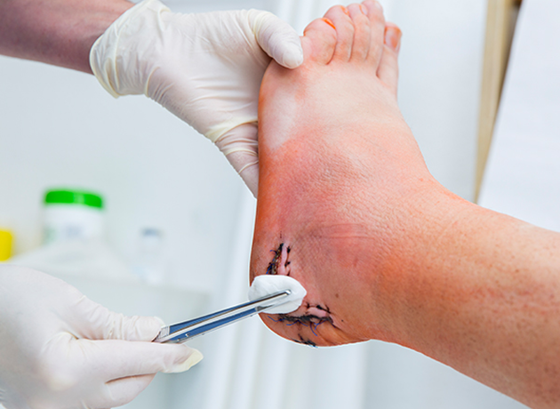 족저근막 유리술 이미지