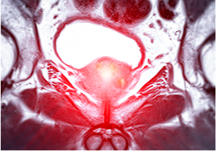 양성 척추 종양 환자인 경우