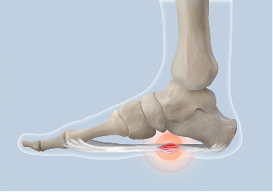 보존적 치료에도 불구하고 호전되지 않거나 발바닥 통증이 심해지는 경우